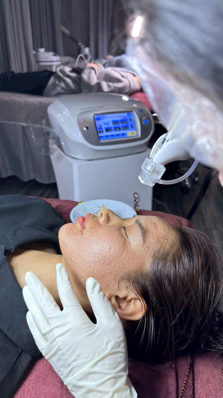 cang bong da meso tien cho lan da cang bong 672ecf8878d32