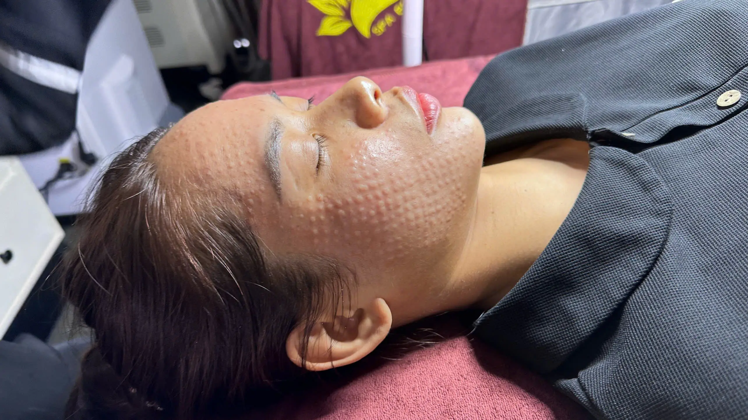 cay meso cang bong da 672ecc93cdead