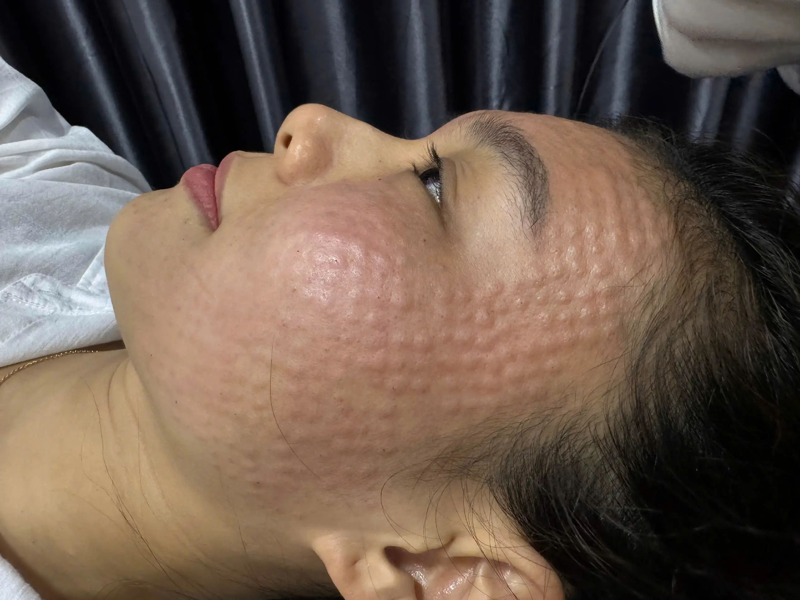 kham pha cong nghe cang bong da meso tien tien bi quyet so huu lan da cang bong tre trung 672ecf5752dbb