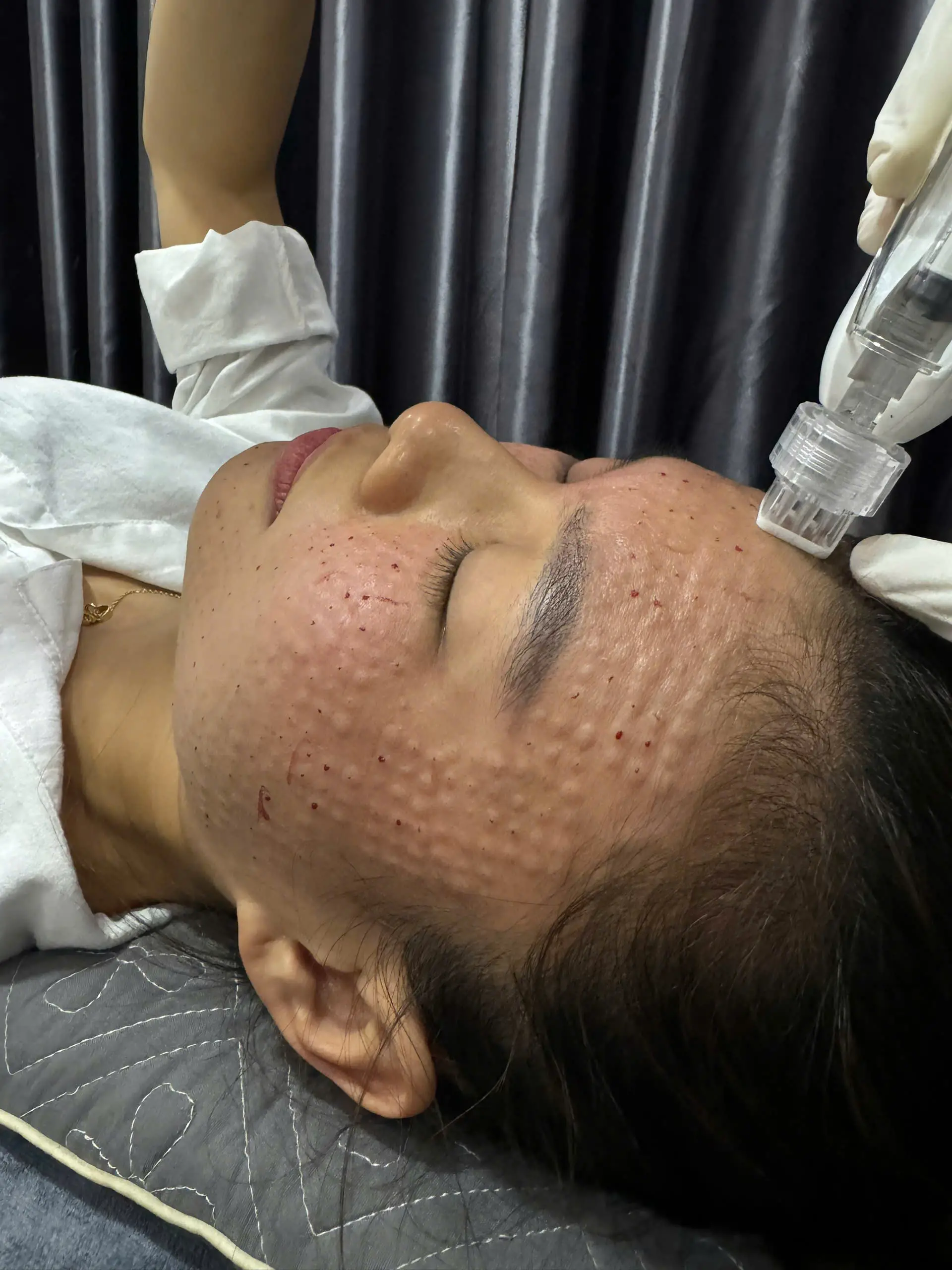 tiem cang bong da meso 672ecd78848b1