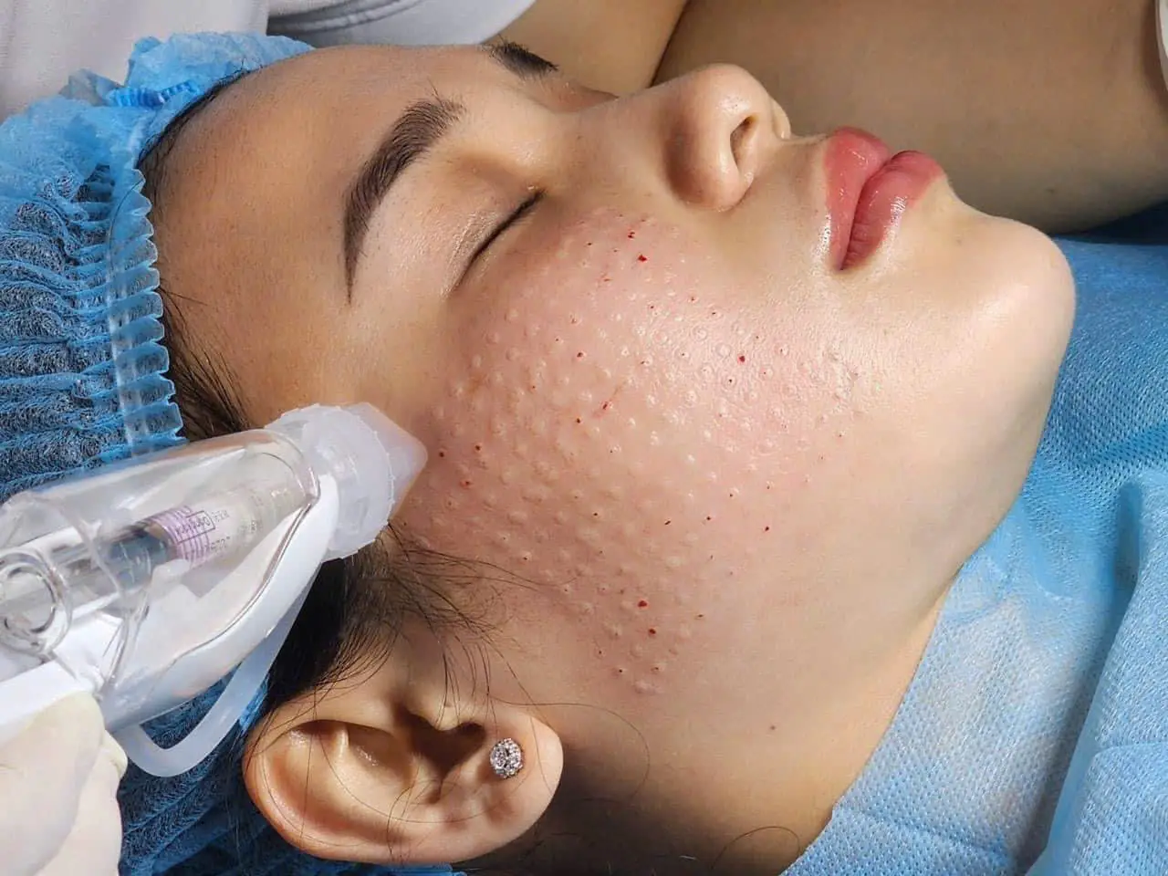 tiem meso cang bong da 6729ad179a0ac