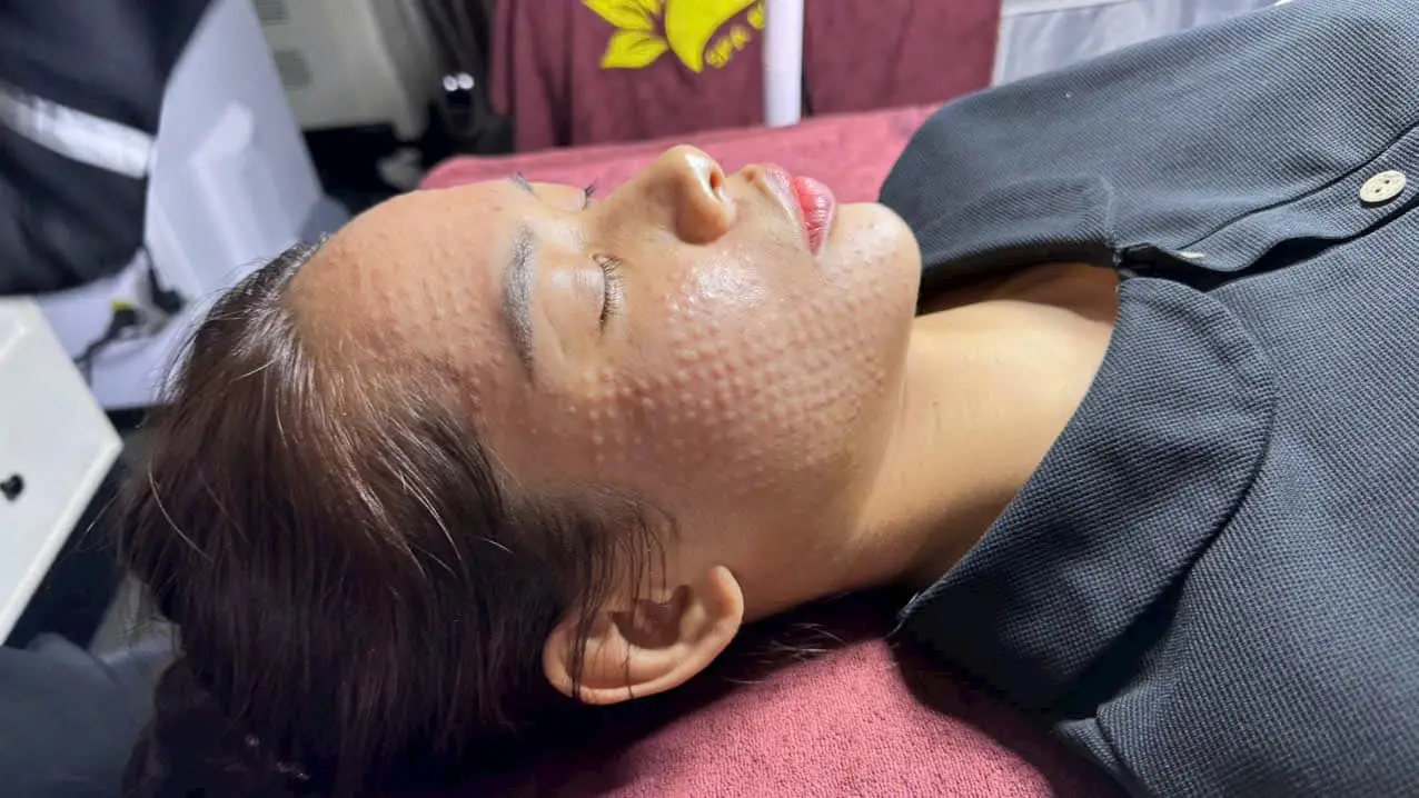 tiem meso cang bong da gia bao nhieu 6729af1a874f5