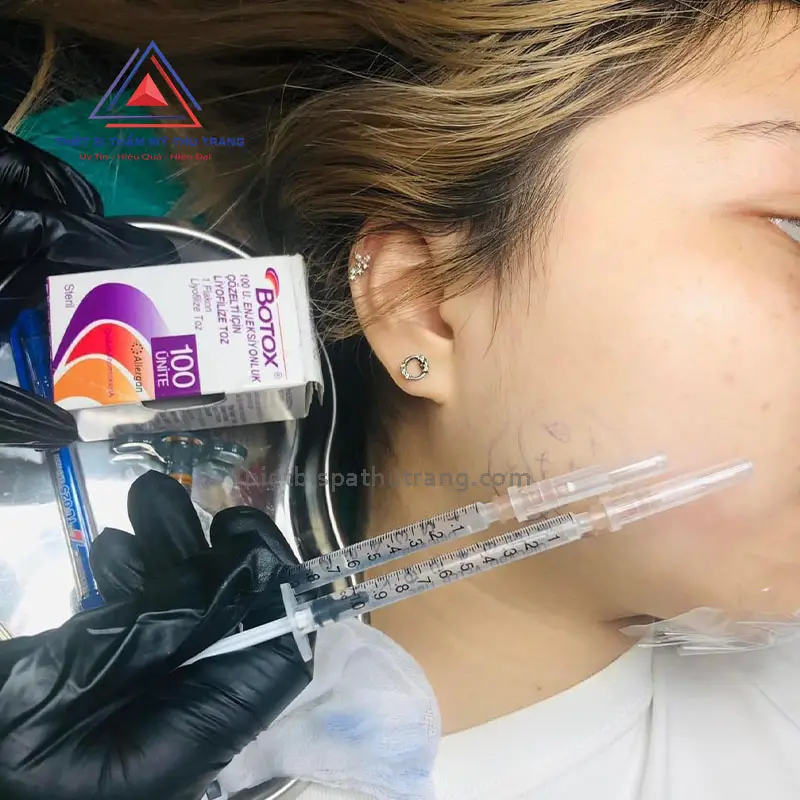 truoc va sau khi tiem botox gon ham 672865eddaaee
